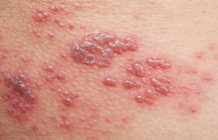 picture of shingles virus